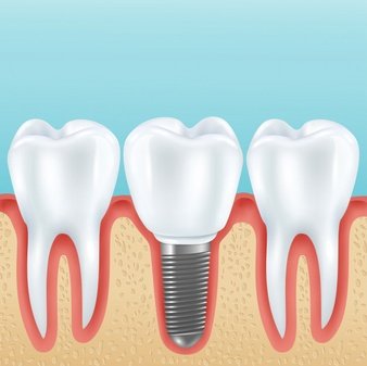 5 Major Reasons to Replace a Missing Tooth