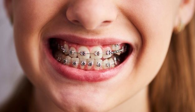 The Many Benefits of Orthodontics & Braces for Adults