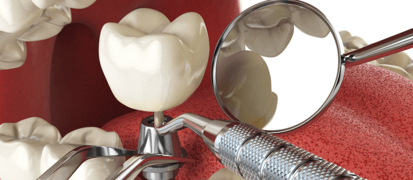 How Long Does a Dental Implant Take?
