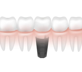 What are the Benefits of Getting Dental Implants?