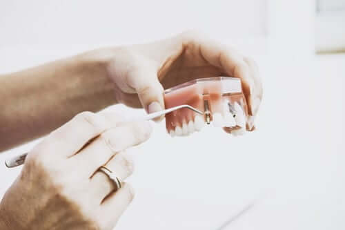 Dental Implants Vs Dentures