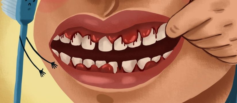 Four Ways To Stop And Prevent Bleeding Gums