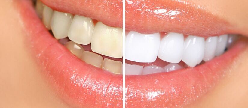 Zoom Whitening: Is it Right for You?