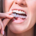 Invisalign for Teeth Straightening