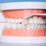 image of dental veneer being matched to teeth on a plastic dental model, used for cosmetic dentistry and tooth restoration